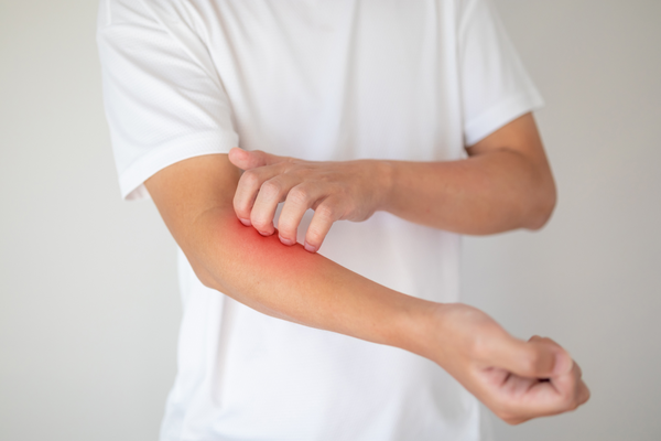 Dermatite da sudore: sintomi, cause e rimedi per alleviare il prurito estivo